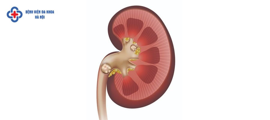 Nên khám thận ở đâu Hà Nội? Nên khám thận ở đâu Hà Nội?