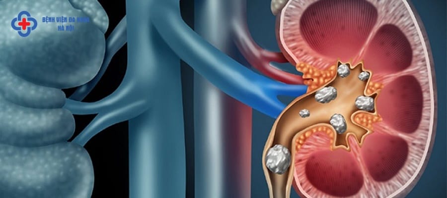 Mổ sỏi thận có nguy hiểm không? Mổ sỏi thận có nguy hiểm không?