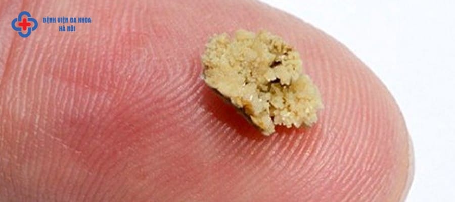 Sỏi thận bao nhiêu thì phải mổ? Sỏi thận bao nhiêu thì phải mổ?