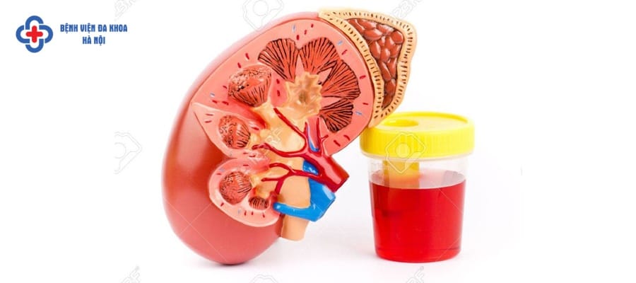 Mệt mỏi, sốt cao kéo dài sau tán sỏi rất nguy hiểm Mệt mỏi, sốt cao kéo dài sau tán sỏi rất nguy hiểm