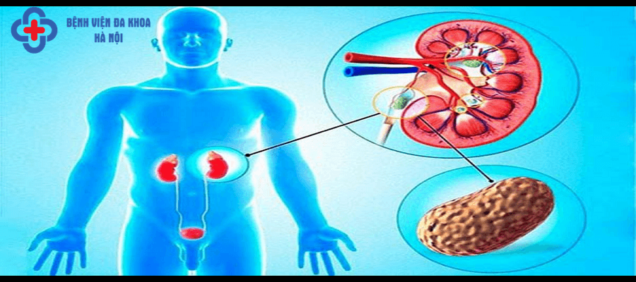 Sỏi đường tiết niệu là căn bệnh thường gặp hiện nay