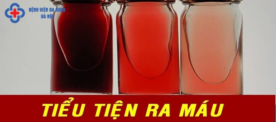 Triệu chứng sỏi đường tiết niệu thường gặp nhất là tiểu rắt, tiểu ra máu