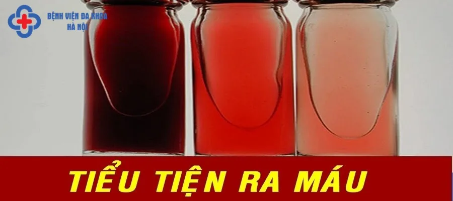 Triệu chứng sỏi đường tiết niệu thường gặp nhất là tiểu rắt, tiểu ra máu
