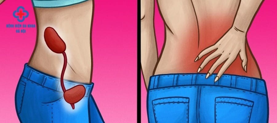Sỏi thận, sỏi tiết niệu nên chữa sớm để tránh biến chứng