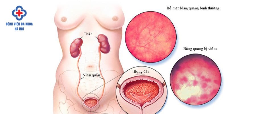 Điều trị sớm để viêm bàng quang không gây biến chứng
