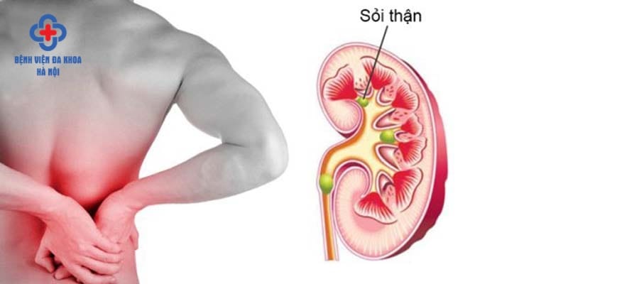 Sỏi thận gây đau đớn dữ dội cho người bệnh