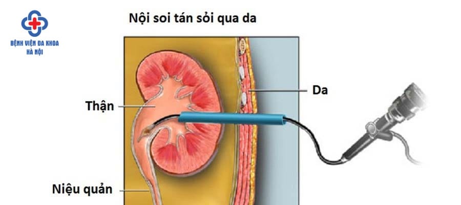 Phương pháp tán sỏi qua da, ít xâm lấn, nhanh hồi phục