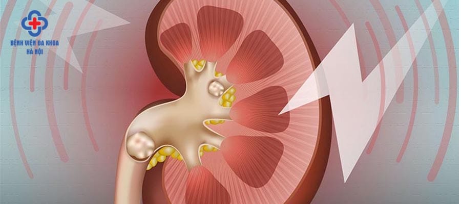 Cần cảnh giác với các biến chứng sau mổ sỏi thận mo soi than