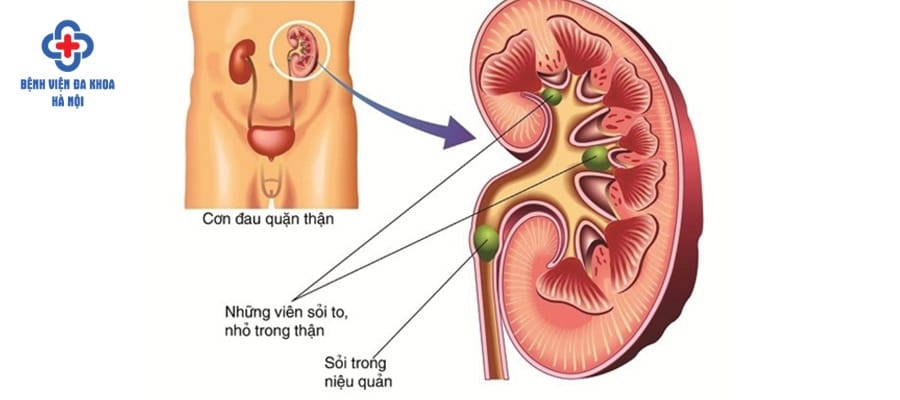 Sỏi niệu quản nên điều trị ở bệnh viện uy tín