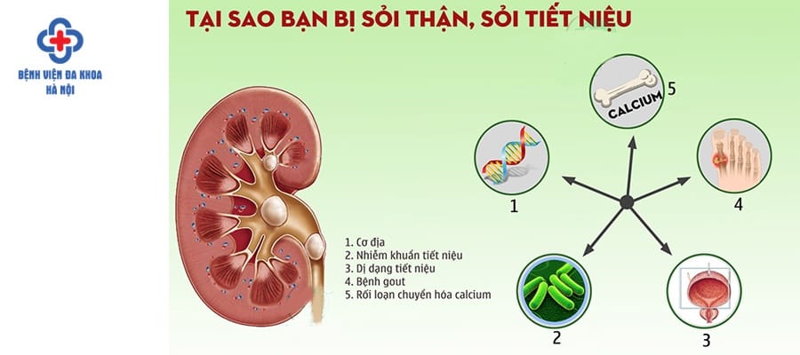 Những nguyên nhân điển hình gây sỏi tiết niệu