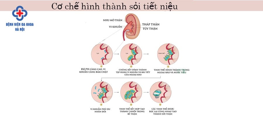 Hình ảnh mô phỏng cơ chế hình thành nên sỏi tiết niệu