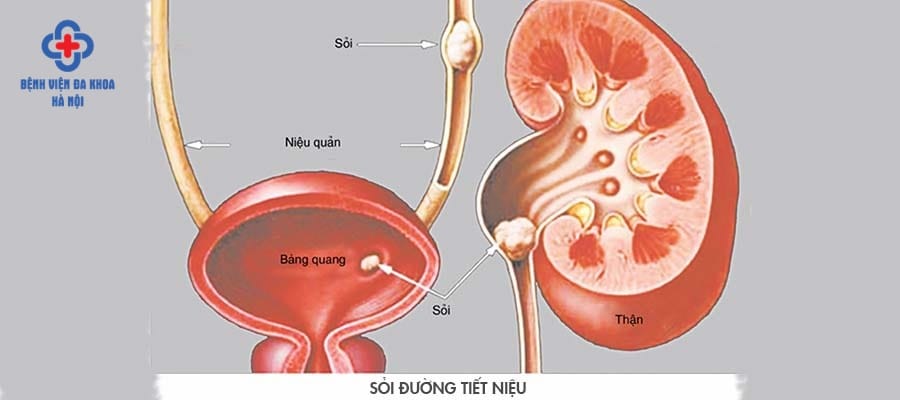 Vị trí của sỏi niệu quản