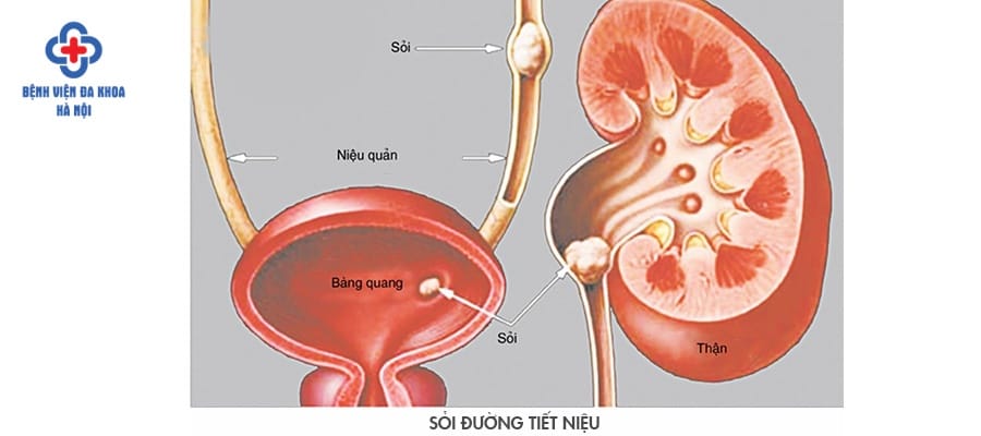 Sỏi thận gây ra các cơn đau cho người bệnh