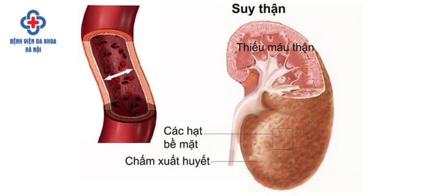 Điều trị không kịp thời và đúng cách có thể gây suy thận