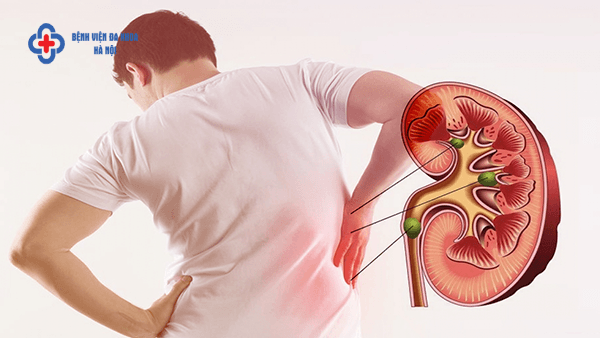 Khám sỏi thận ở đâu? Khám sỏi thận ở đâu?
