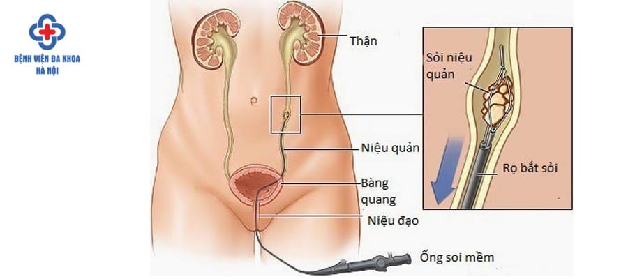 Tán sỏi ngược dòng-Kỹ thuật tán sỏi hiện đại, an toàn