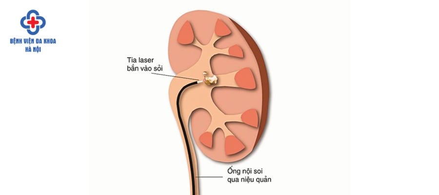 Sỏi thận nên được phát hiện, điều trị sớm