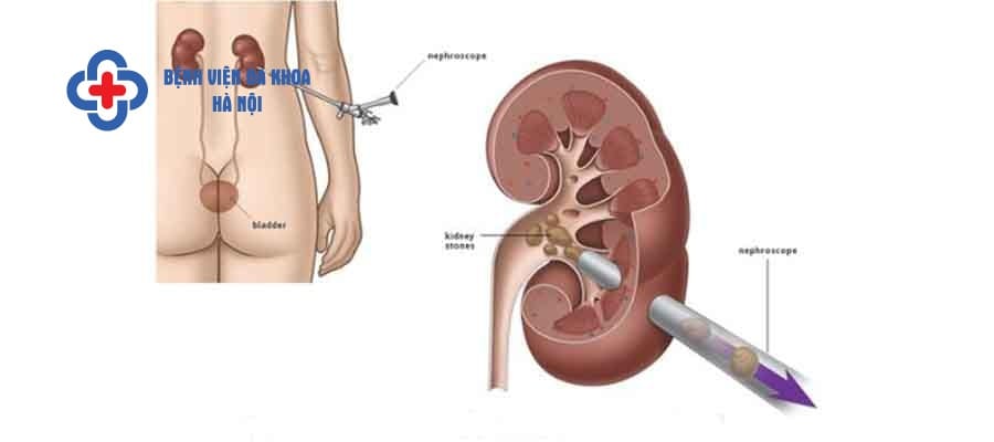 Tán sỏi qua da có thể điều trị sỏi an toàn, không để lại sẹo