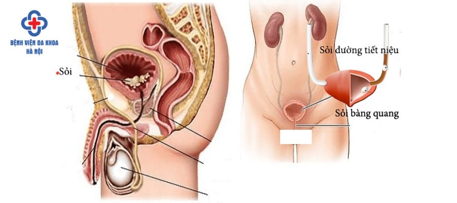Sỏi bàng quang gây nên nhiều biến chứng nguy hiểm