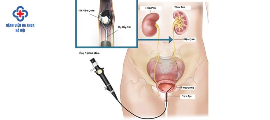 Phương pháp tán sỏi niệu quản an toàn hiện nay