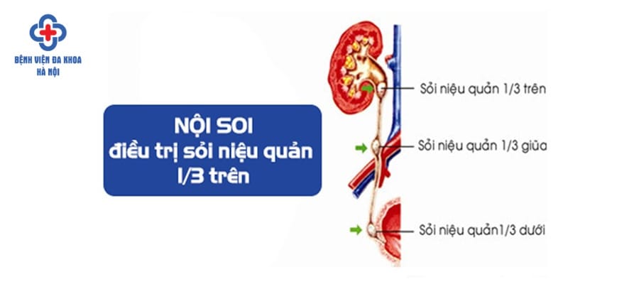 Xác định đúng vị trí để điều trị đạt hiệu quả cao sỏi niệu quản 1/3 trên có nguy hiểm không