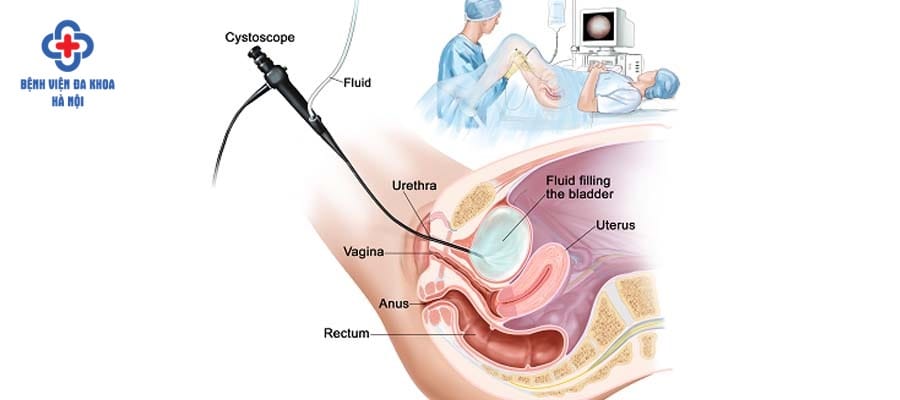 Kỹ thuật tán sỏi ngược dòng ít xâm lấn, an toàn