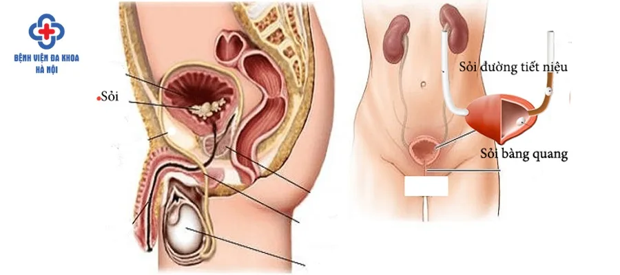 Sỏi bàng quang gây ra các cơn đau quặn