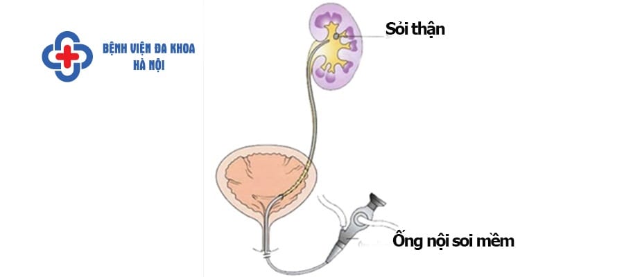 Tán sỏi nội soi bằng ống mềm
