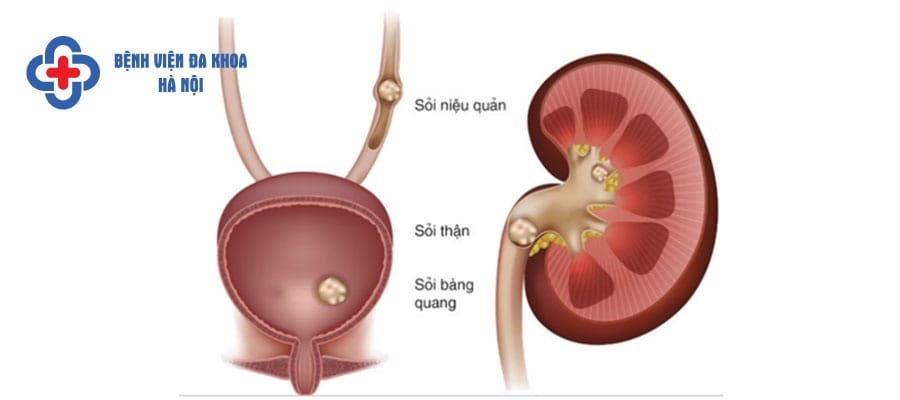 Sỏi thận có thể gây ra các cơn đau quặn ở thắt lưng