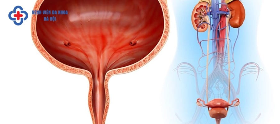 Bàng quang có dị vật tạo điều kiện cho sỏi hình thành