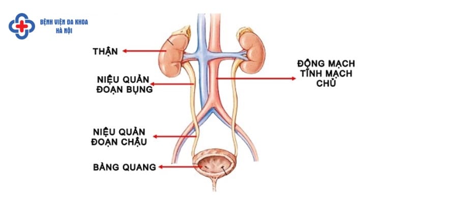 Bệnh sỏi đường tiết niệu cần phát hiện điều trị sớm