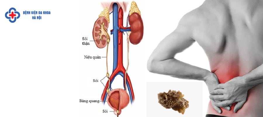 Sỏi tiết niệu có thể gây nên nhiều biến chứng nguy hiểm. bien chung soi tiet nieu