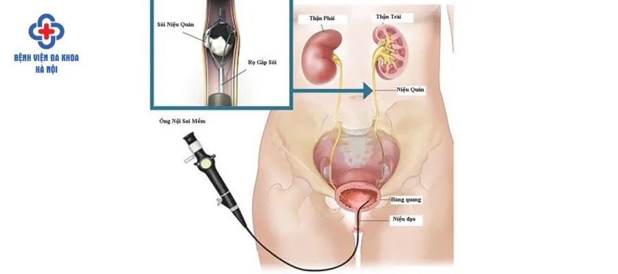 Phương pháp tán sỏi nội soi-kỹ thuật mũi nhọn chữa sỏi bàng quang