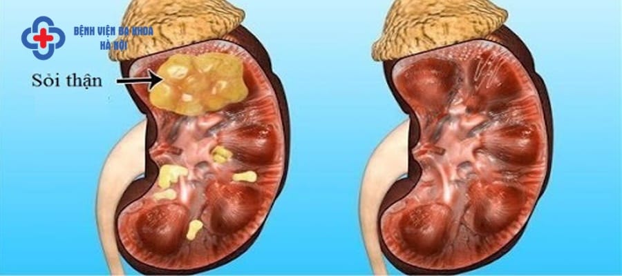 Các khoáng chất trong nước tiểu dư thừa tạo thành sỏi thận