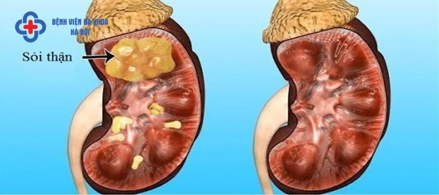 Các khoáng chất trong nước tiểu dư thừa tạo thành sỏi thận