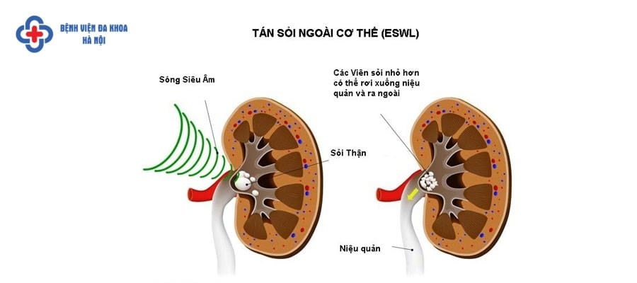 Phương pháp tán sỏi ngoài cơ thể Phương pháp tán sỏi ngoài cơ thể