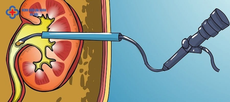 Tán sỏi qua da đường hầm nhỏ Tán sỏi qua da đường hầm nhỏ