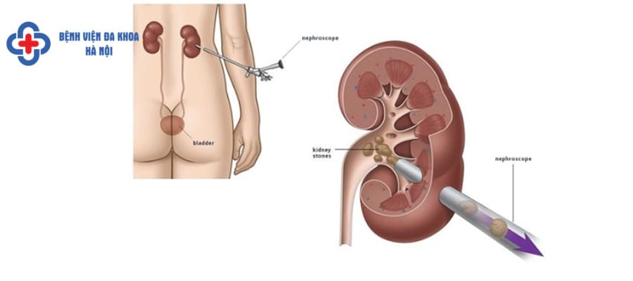 Tán sỏi có nhiều ưu điểm vượt trội so với mổ mở cach chua benh soi than hieu qua