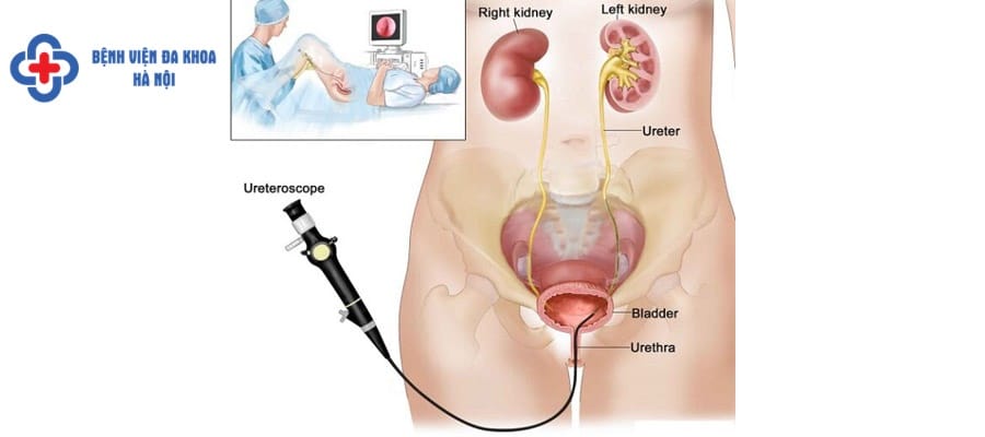 Phương pháp tán sỏi nội soi ngược dòng