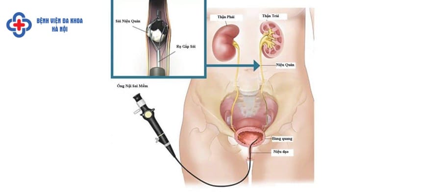 Tán sỏi nội soi ngược dòng với nhiều ưu điểm cach chua soi than hieu qua nhat