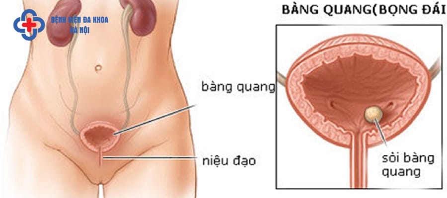 Cặn nước tiểu kết tinh thành sỏi bàng quang