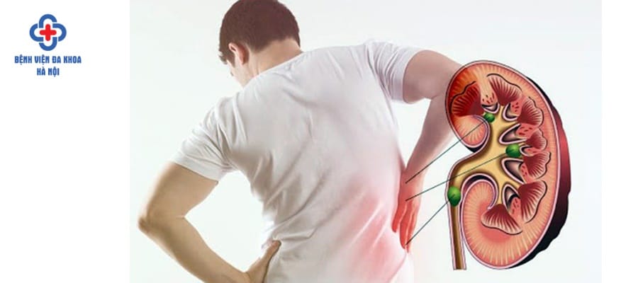 Điều trị sớm để ngắt các cơn đau quặn do sỏi