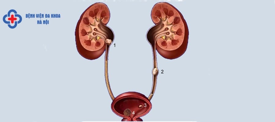 Bệnh nhân sau tán sỏi niệu quản cần chăm sóc chu đáo cham soc benh nhan tan soi