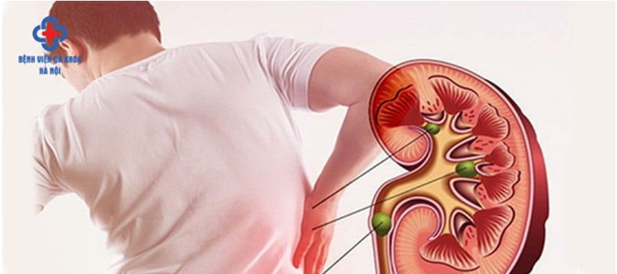 Bệnh sỏi thận gây đau đớn và phiền toái cho người bệnh