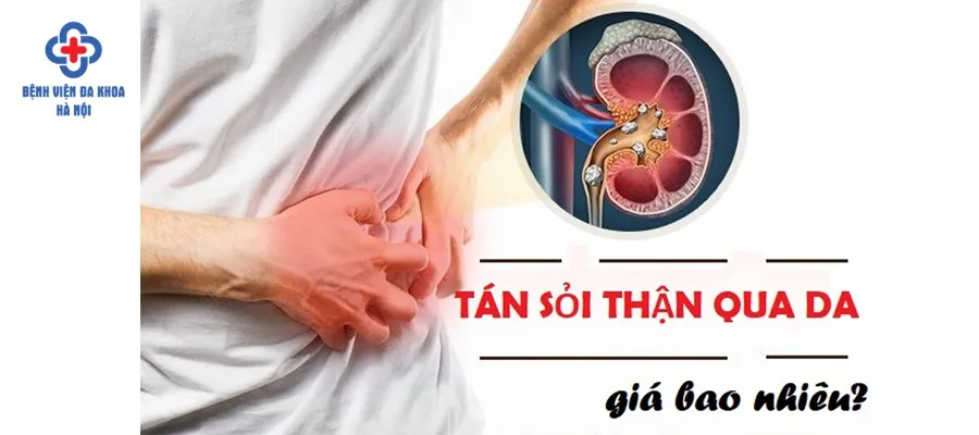 Chi phí tán sỏi phụ thuộc vào nhiều yếu tố