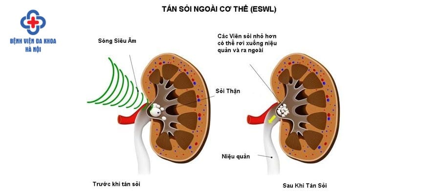 Tuy nhiên phương pháp này vẫn tiềm ẩn nhiều nguy cơ tan soi ngoai co the