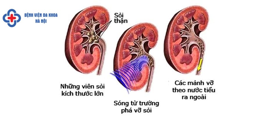 Sỏi thận hay sỏi bàng quang cần được điều trị sớm soi than dieu tri som