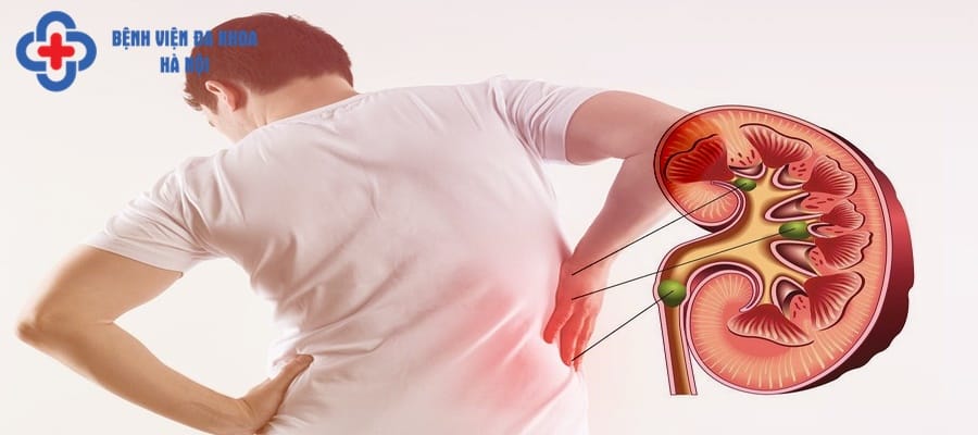 Đau lưng và đau bụng thường xuất hiện khi đau sỏi thận