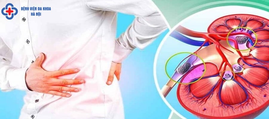 Đau quặn thận xảy ra tại vùng lưng bụng