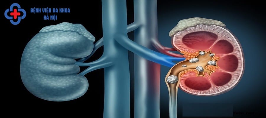 Đau sỏi thận trái tại vị trí thận trái
